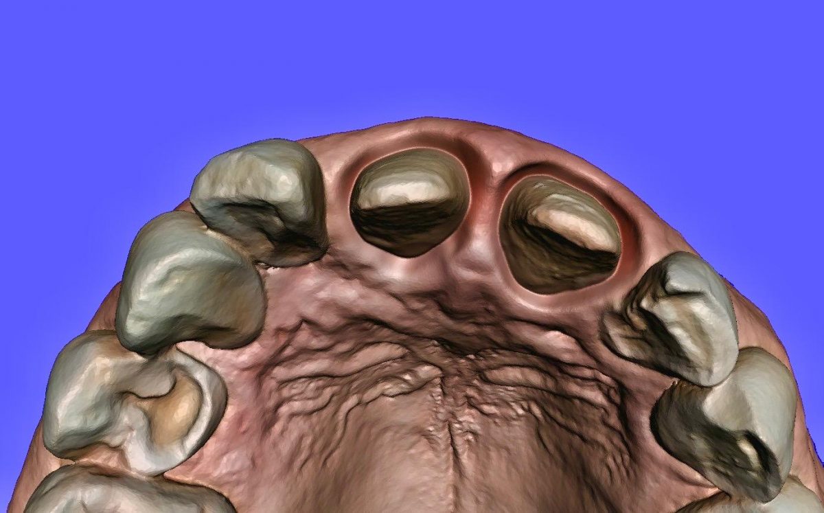 Imágen generada por el Escáner Intraoral